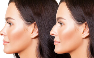 How Does Rhinoplasty Work: Understanding The Basics