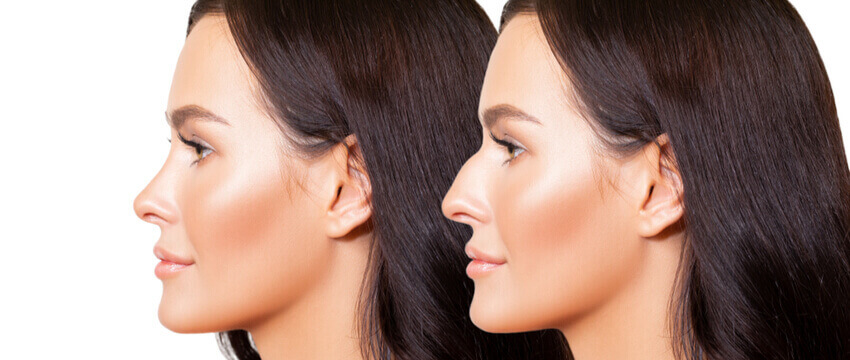 How Does Rhinoplasty Work: Understanding The Basics