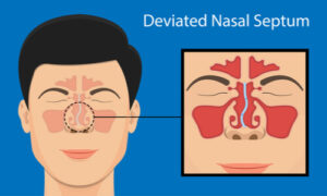 occurrence of deviated nasal septum