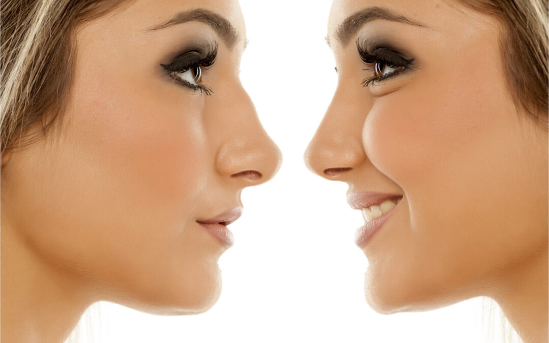Nose Job Before and After Treatment: What To Know About Rhinoplasty
